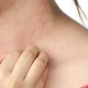 Alergi pada kulit