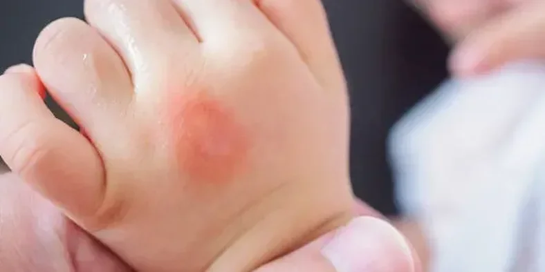 Tangan bayi dengan ruam kulit dan alergi